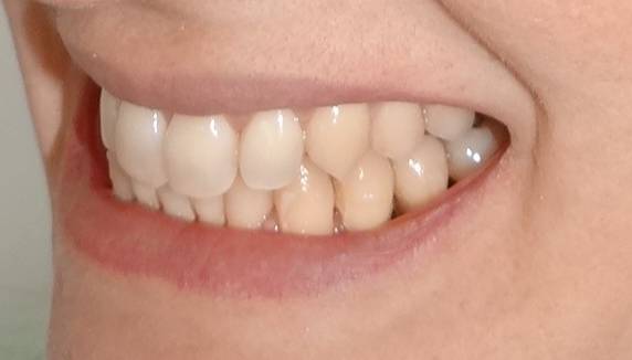 traitement pour dents qui se chevauches Montpellier 