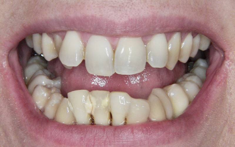 photos avant après dents qui se chevauches Montpellier 