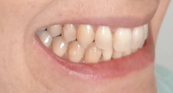 photos avant après dents qui se chevauches herault