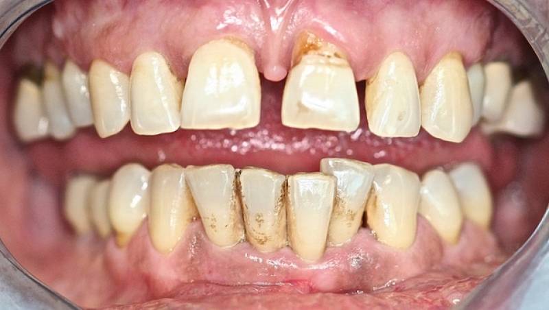 Photo avant après problème parodontie avec alignement diastème des dents  Montpellier 
