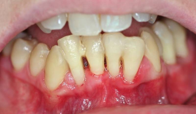 traitement photos avant après dents qui se chevauches Montpellier 