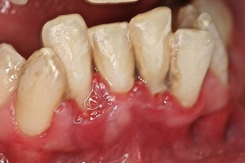 solution et photos avant après dents qui se chevauches Montpellier 