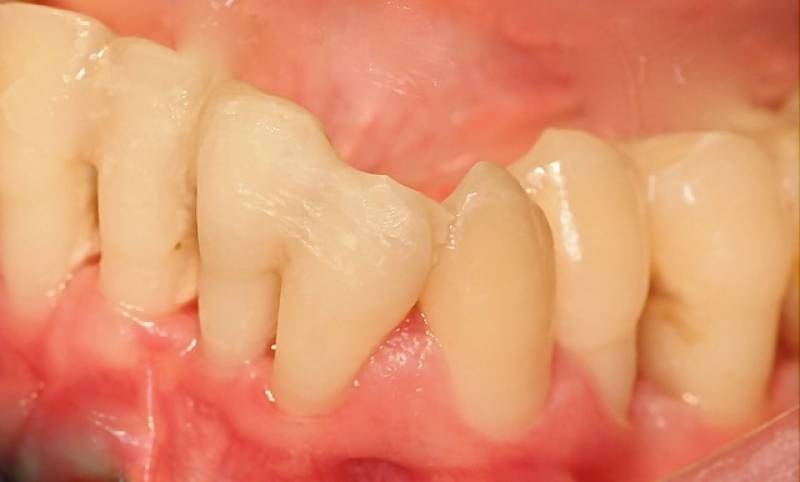 regler une problème de  dents qui se chevauches Montpellier 