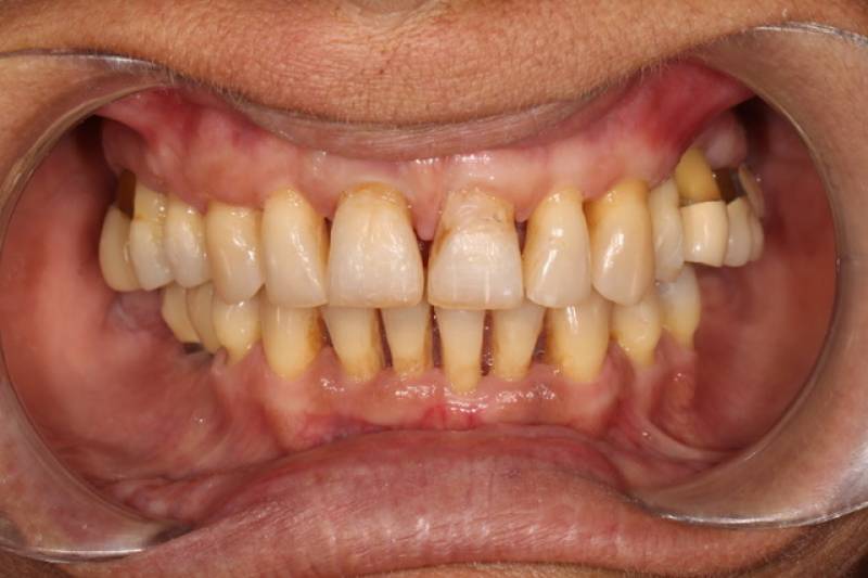 Photo avant après problème parodontie avec alignement diastème des dents Montpellier 