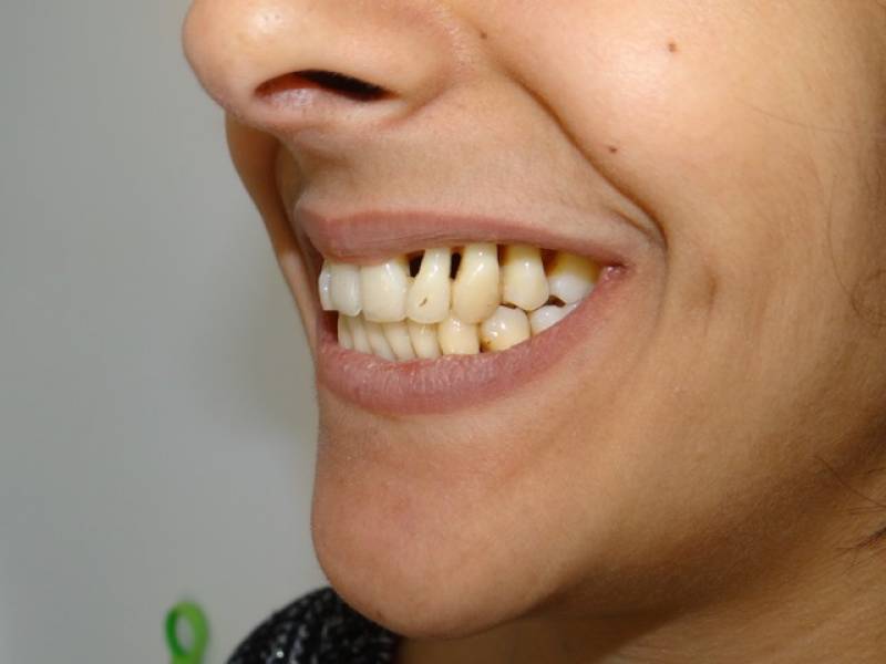 TRAITEMENT PARODONTAL PAR ORTHODONTIE AVEC GOUTTIÈRES SUR CAS EXTRÊME (21 ANS) Hérault 