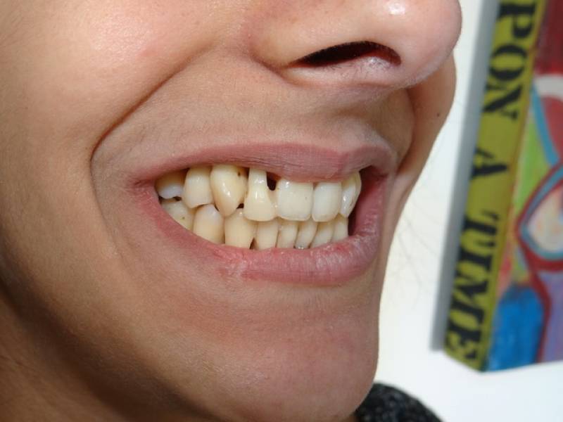 TRAITEMENT PARODONTAL PAR ORTHODONTIE AVEC GOUTTIÈRES SUR CAS EXTRÊME (21 ANS) grabels