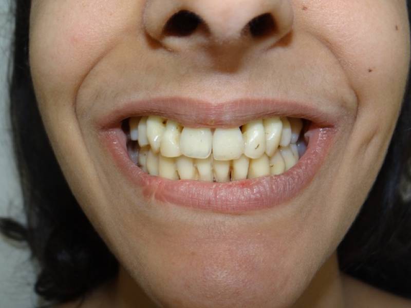TRAITEMENT PARODONTAL PAR ORTHODONTIE AVEC GOUTTIÈRES SUR CAS EXTRÊME (21 ANS) herault 