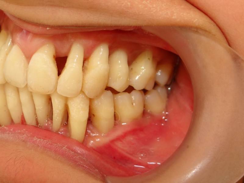 TRAITEMENT PARODONTAL PAR ORTHODONTIE AVEC GOUTTIÈRES SUR CAS EXTRÊME (21 ANS) montpellier 