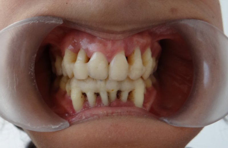 TRAITEMENT PARODONTAL PAR ORTHODONTIE AVEC GOUTTIÈRES SUR CAS EXTRÊME (21 ANS)