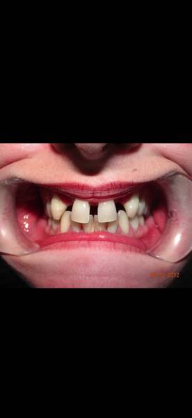 Photos Avant après Problème de agénésie incisives latérales supérieurs et maladie parodontale