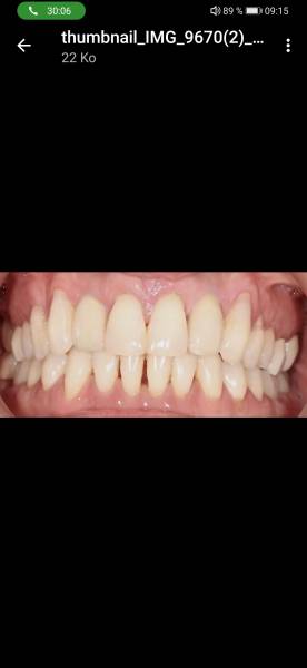 Photos Avant après Problème de agénésie incisives latérales supérieurs et maladie parodontale